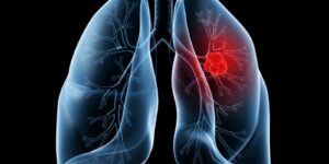 Saiba o que é adenocarcinoma pulmonar, câncer que atinge o Papa Leão